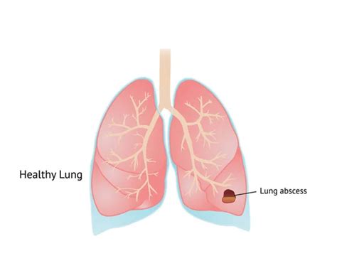 Lung Abscess Surgeon In Delhi Lung Abscess Treatment Dr Pramoj Jindal