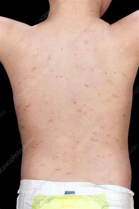 Urticaria Pigmentosa Stock Image C0258064 Science Photo Library