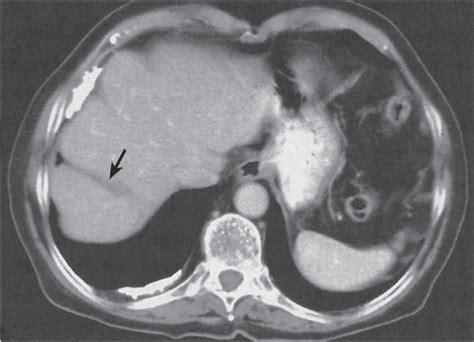 Liver Radiology Key