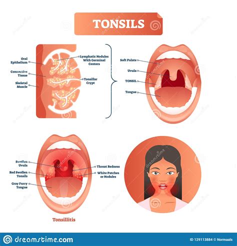 Tonsils Vector Illustration Tonsillitis Labeled Structure Diagram