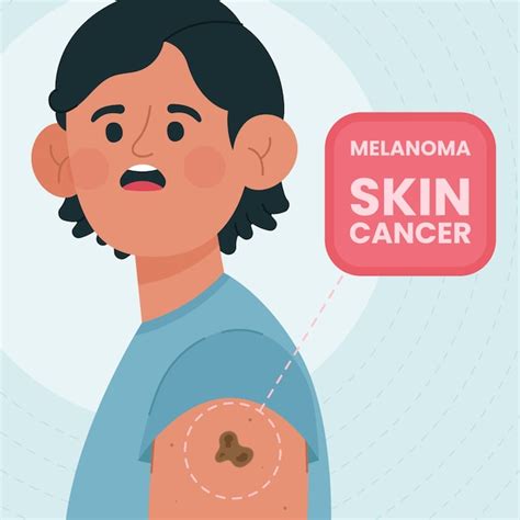 Understanding Melanoma Skin Cancer Prevention Detection And Treatment