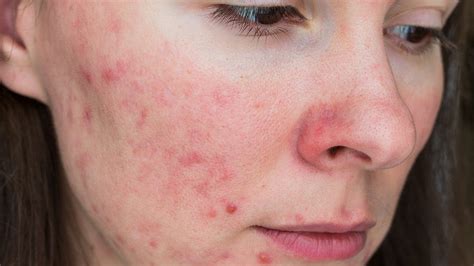 Acne Takes A Toll On Womens Mental Health Quality Of Life Faculty