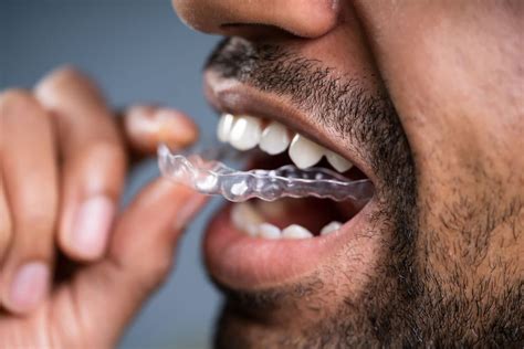 It's best to wear your retainer at night, every night, to protect your teeth. Retainers After Braces & Invisalign | Andover Orthodontics
