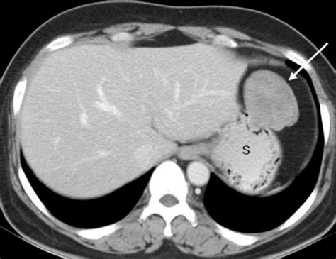 Contrast Enhanced Ct Scan At The Level Of The Gastric Cardia Shows A