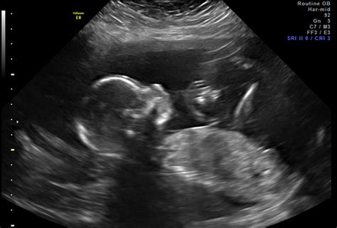 What To Expect At Your 18 Week Ultrasound And Pictures Of Our Baby