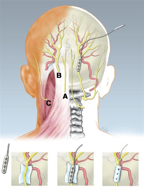 Figure 20 2 From Occipital Nerve Stimulation For Intractable Occipital