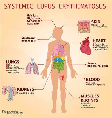 19 Ways To Heal Systemic Lupus Naturally