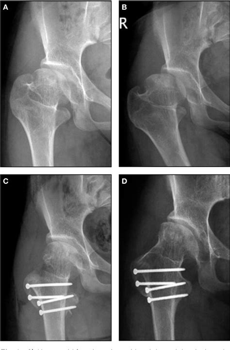 Figure 1 From The Lesser Trochanter As A Cause Of Hip Impingement