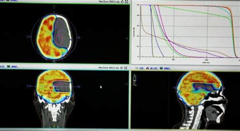 肿瘤放疗科采用图像引导容积旋转调强放疗VMAT技术成功治疗恶性肿瘤患者 例 西安高新医院