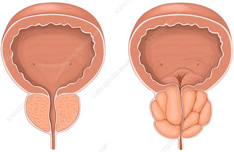 Normal Versus Enlarged Prostate Gland Illustration Stock Image F0266740 Science Photo