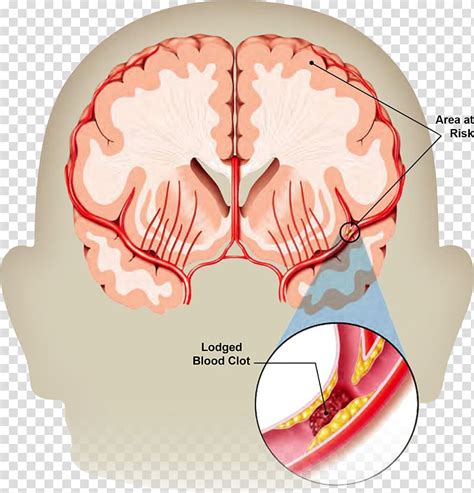 Stroke Transient Ischemic Attack Neurology Brain Haemorrhage Health