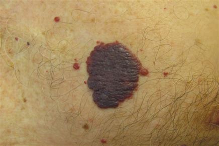 They are the most common vascular proliferations in the skin. Vascular nodules and papules - Page 3 of 3 - Clinical Advisor