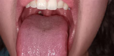 White Lump On Right Tonsil Looks Tooth Like Any Guesses Seems To