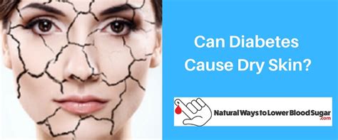 Can Diabetes Cause Dry Skin 11 Tips To Keep Skin Healthy