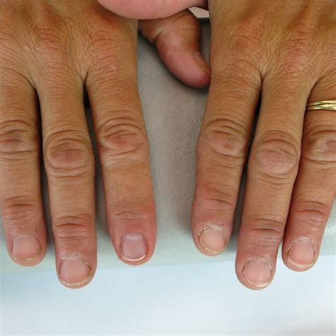 Finger Prosthesis Hand Prosthesis Milwaukee Wi — Life Like Prosthetics