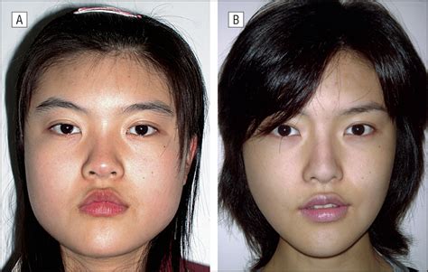 experience in east asian facial recontouringreduction malarplasty and mandibular reshaping