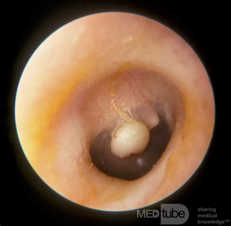 Epidermal Cyst Tympanic Membrane Picture