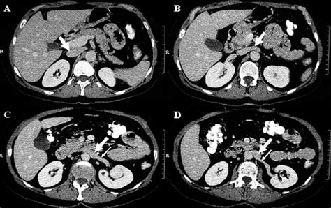 Abdominal Ct Scan Illustrates The Ivc As It Courses From The Normal