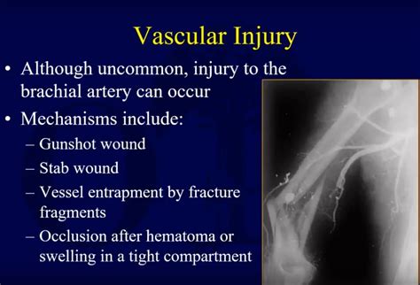 Humeral Shaft Fractures Management Of Complications