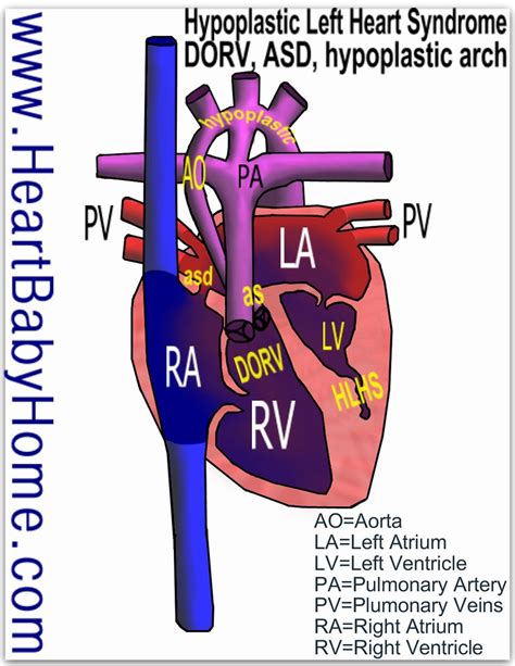 36 Hypoplastic Left Heart Sydrome With Dorv And Asd Flickr