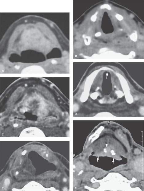 Larynx Malignant Tumors Radiology Key