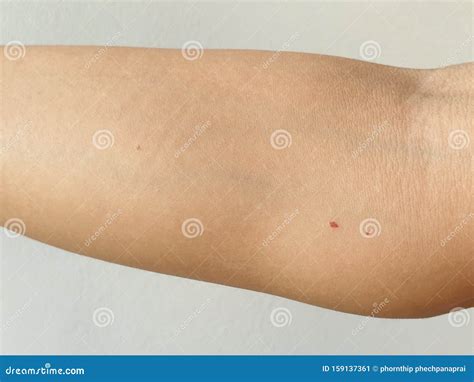 Cherry Angiomas Red Mole Red Mark On Arm Skin Red Dot Suddenly