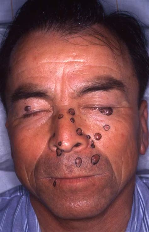 Nevoid Basal Cell Carcinoma Syndrome Nbccs Intechopen