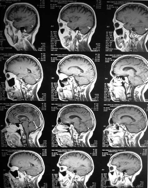Hipoxia Cerebral Qué Es Síntomas Consecuencias Y Más