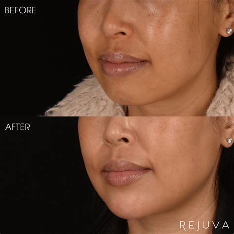Chin And Jawline Filler Rejuva Medical Aesthetics
