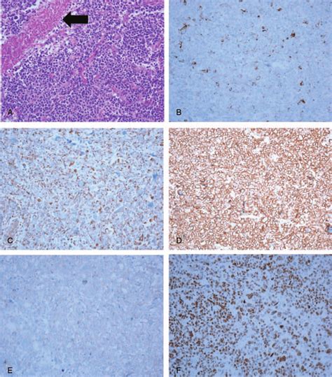 Microscopic Findings And Immunohistochemical Results Of Large Cell