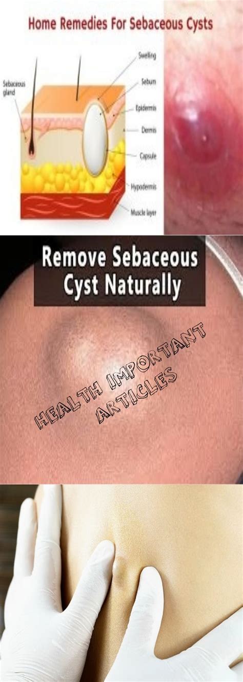 13 natural home remedies for sebaceous cyst health important articles natural home remedies