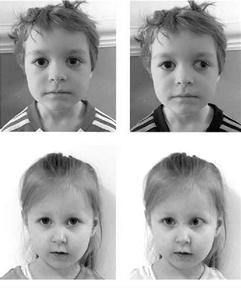 Figure 2 From The Consequences Of Strabismus And The Benefits Of Adult Strabismus Surgery