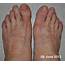 Tops Of Feet Itchy  Pictures Photos