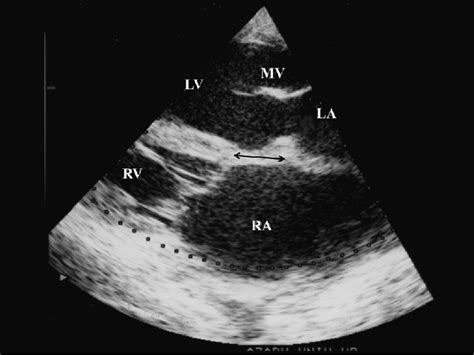 Ultrasonographic Image Of The Heart In The Calf With Cervical Ectopia