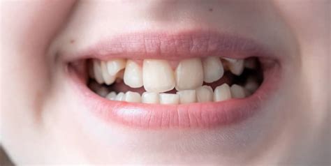 Crooked Teeth In Teens Causes And Best Treatment