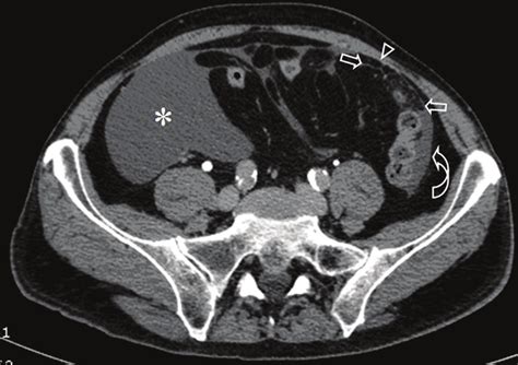 Contrast Enhanced Ct Of The Abdomen Shows Abundant Peritoneal Fluid In