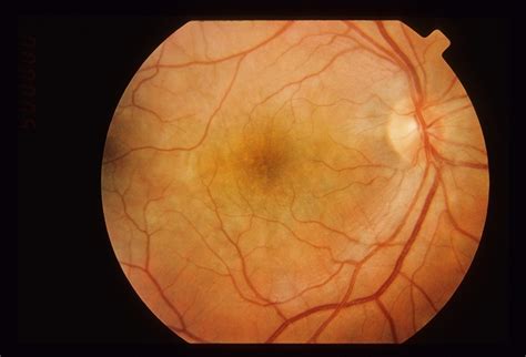 Acute Multifocal Placoid Pigment Epitheliopathy Amppe Retina Image Bank