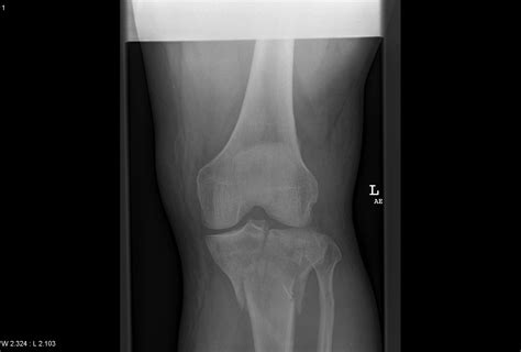 Tibial plateau fractures are complex injuries of the knee. Tibial Plateau Fractures - Core EM