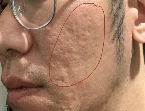 Suggestions Needed For Acne Scars With History Of Keloid Scar