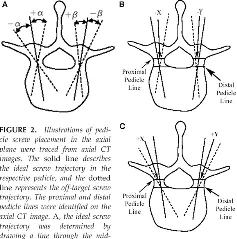 Figure 2 From Accuracy Of Pedicle Screw Placement For Lumbar Fusion