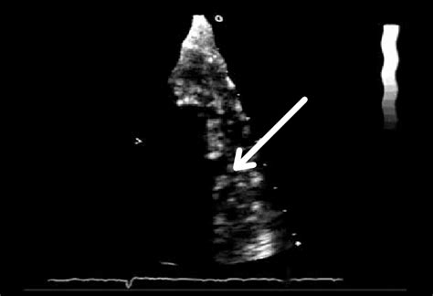 Figura N°2ecocardiografía Transtorácica En Modo 2d Con Ampliación