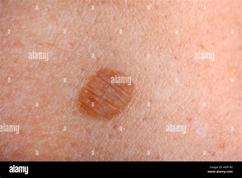 Age Spot Also Known As Liver Spot Stock Photo Alamy