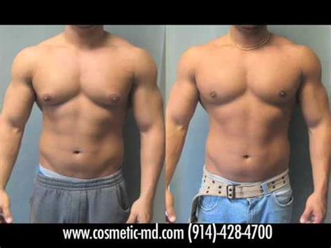 On Gynecomastia Patients From The Austin San Antonio Dallas Texas