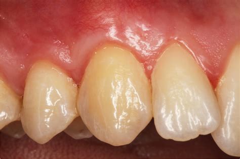Treatment Of Gingival Recession When And How Imber International