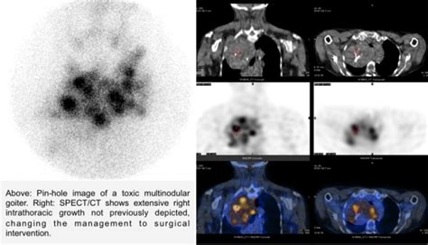 Spectct Imaging In Large Multinodular Goiters And Poorly Defined