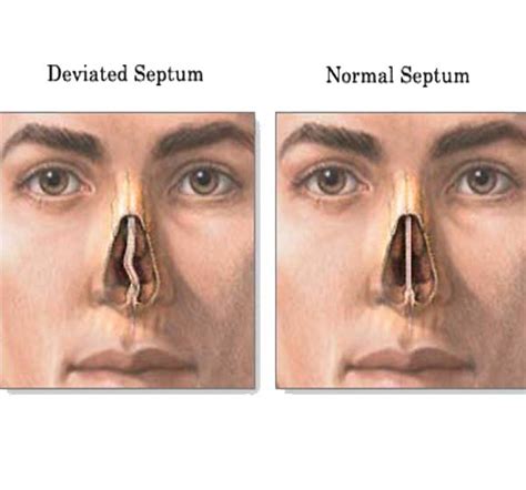 Recovering From Septoplasty And Turbinate Reduction Surgery Diagnosing