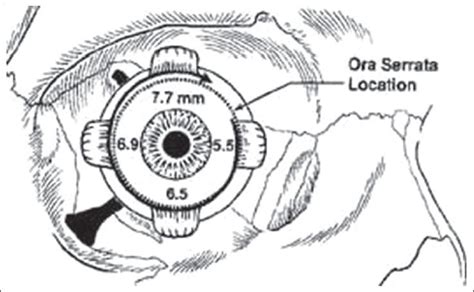 Anterior View Of The Right Globe Spiral Of Tillaux Is