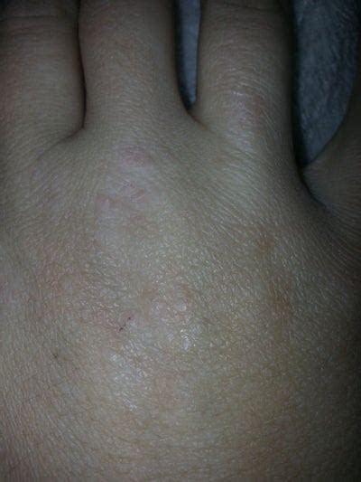 What Are These Small Bumps On The Backs Of My Hands Photo Doctor