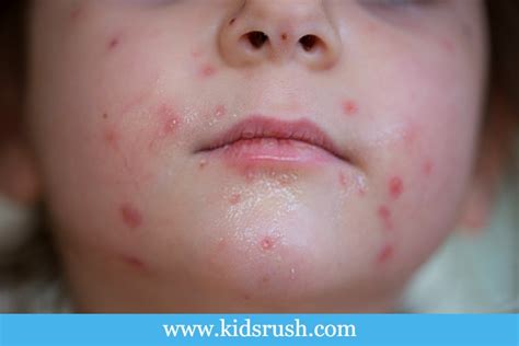 Causes Of Pimples On Babys Skin