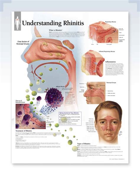 Understanding Rhinitis Exam Room Anatomy Poster Clinicalposters